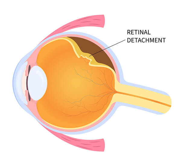 Retinal detachment illustration