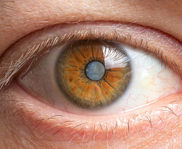 What Are Cataracts?