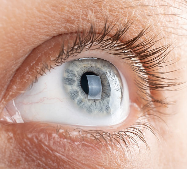 What Are Corneal Diseases?